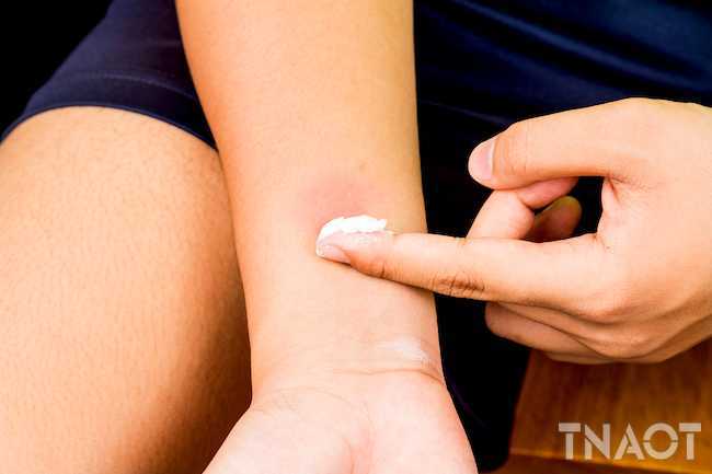 493ss_thinkstock_rf_woman_applying_baking_sodepia_to_bug_bite.jpg